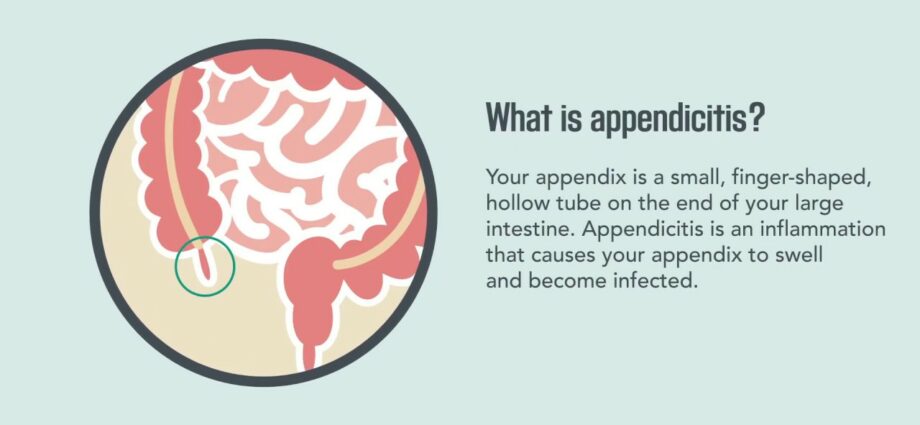 Appendicitis: symptoms and signs. Video