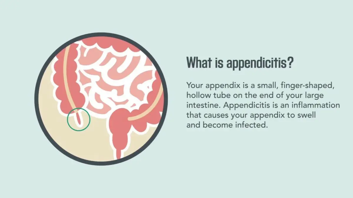 Appendicitis: symptoms and signs. Video