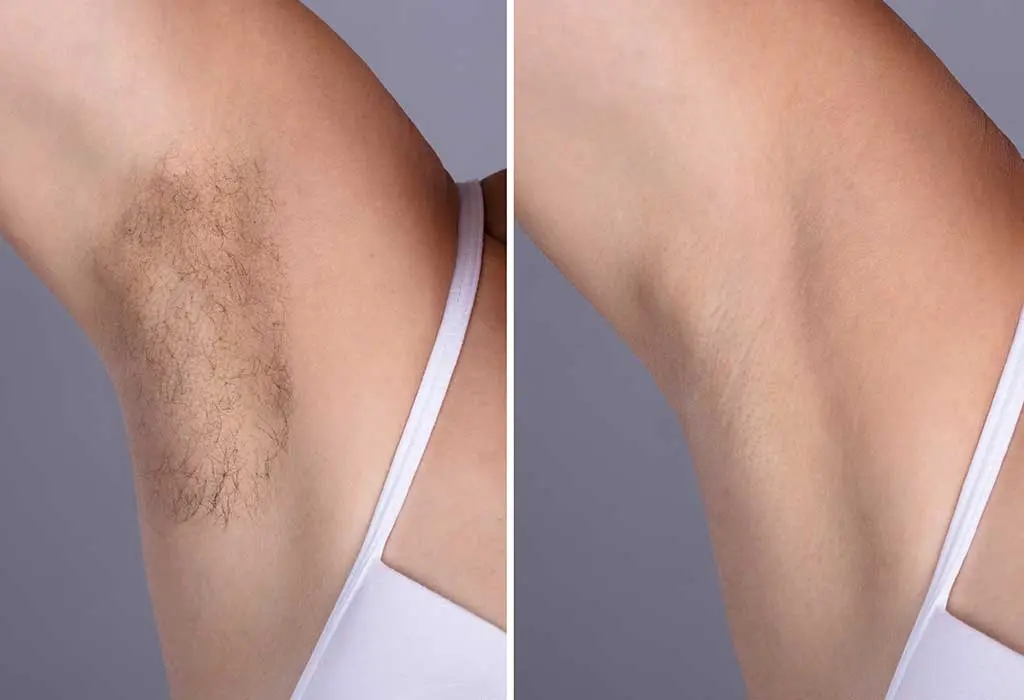 Armpit hair removal: which is the best way? Video