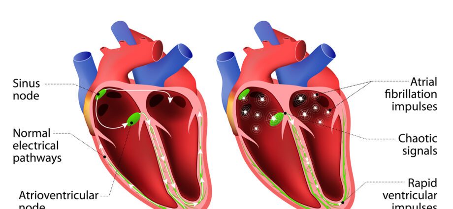 Arrhythmia, kelainan irama jantung