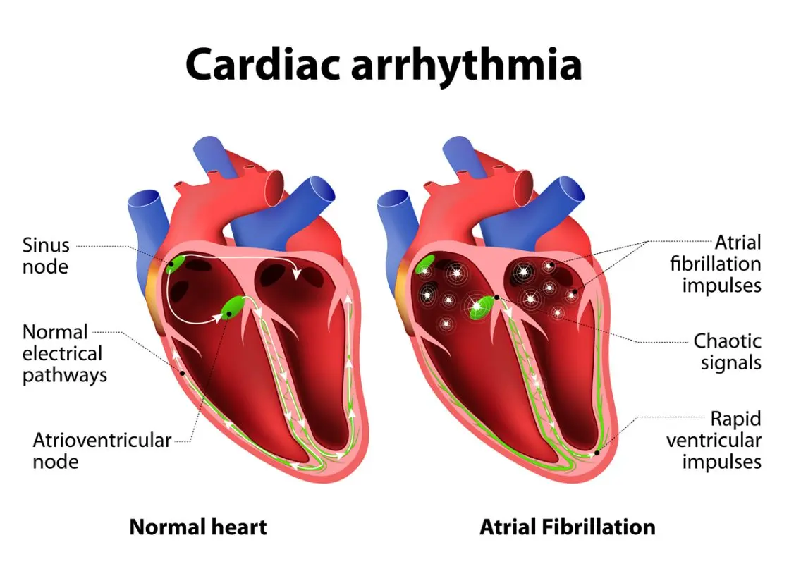 Arrhythmia, a heart rhythm disorder