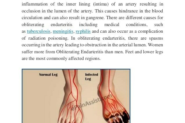 Arteritis obliterans of the lower extremities (PADI)