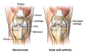 Arthroplasty