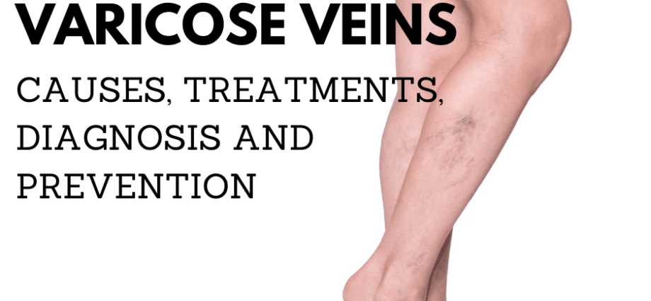 Asymptomatic varicose veins: when to sound the alarm and see a doctor