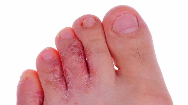 Atletsko stopalo (gljivična infekcija)