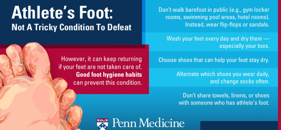 腳氣——我們的醫生的意見