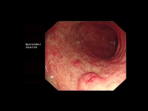 Atrophic gastritis of the stomach: video