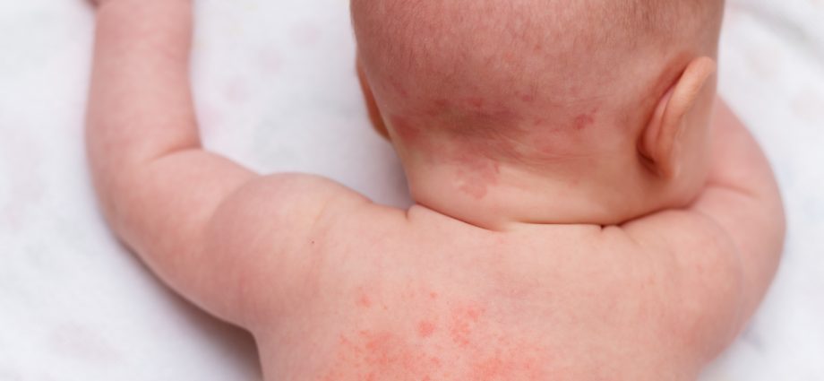 Baby has heat rash: taking care of baby&#8217;s skin