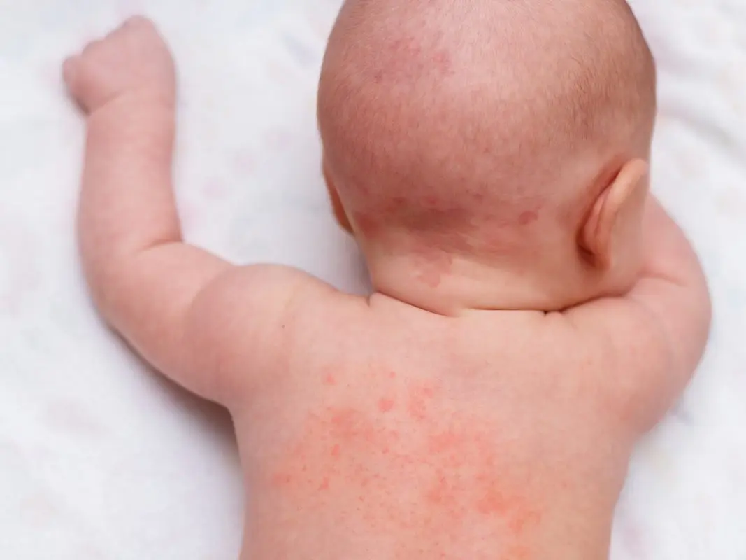 Baby has heat rash: taking care of baby&#8217;s skin