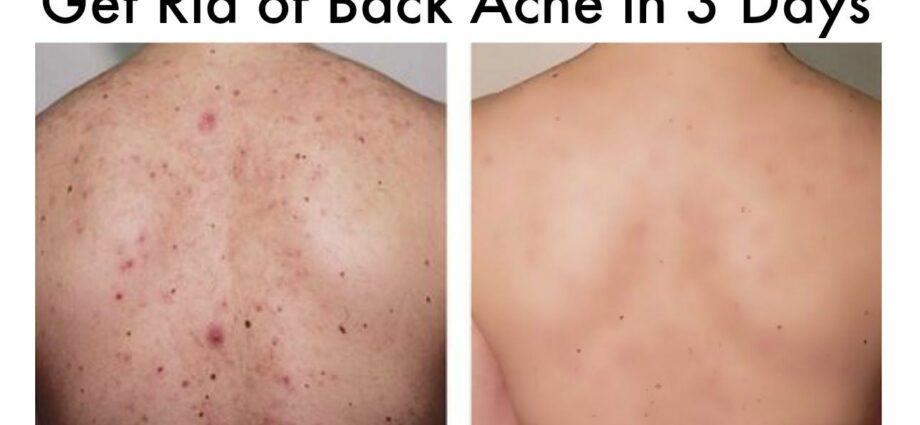 Back acne: how to get rid of acne? Video