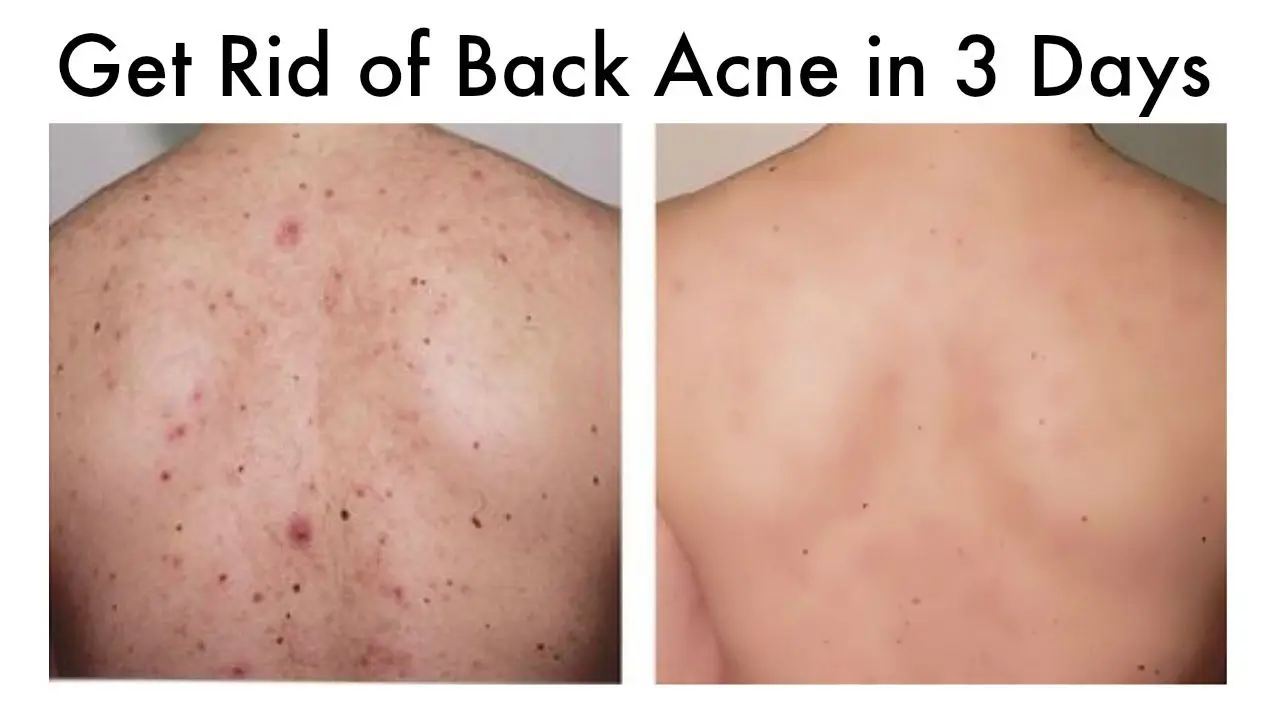 How to get rid of back acne? Video