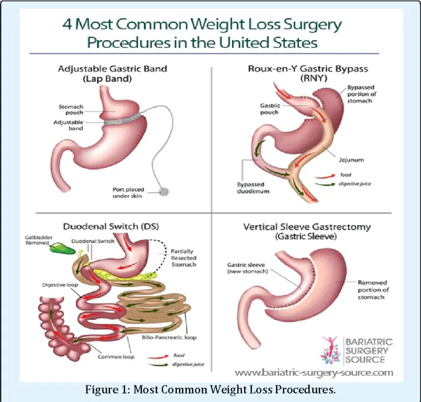 Bariatric surgery for type XNUMX diabetes