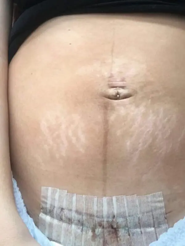 Beauty blogger openly showed what happened to her body after cesarean