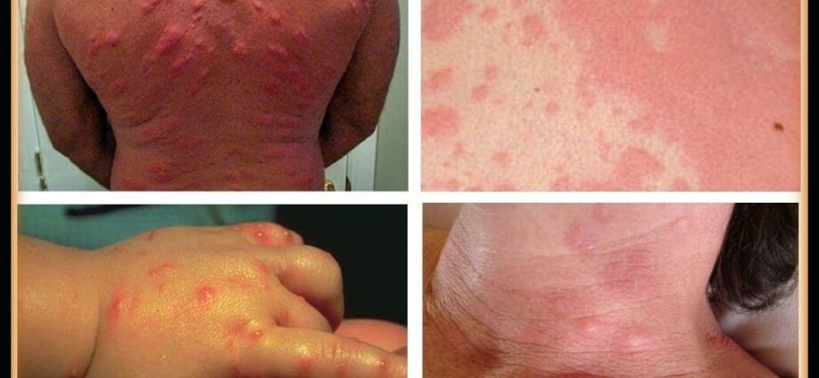 Alerģija pret gultas blaktīm: kā tos atpazīt kā alerģiju?