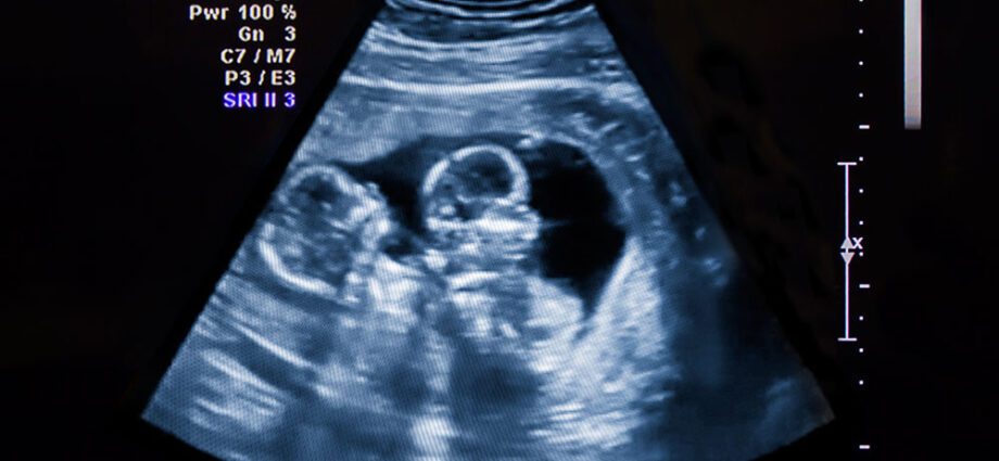 Я вагітна двійнею: що це змінить?