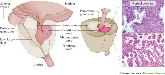 Gerybinė prostatos hipertrofija – dominančios vietos