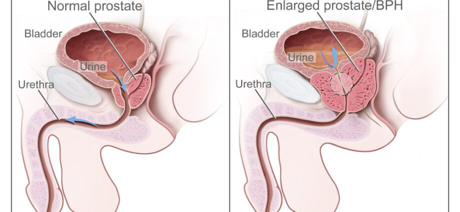 Benign prostatic hyperplasia