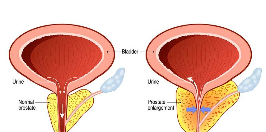 Hiperplasia prostat jinak – Pendapat dokter kami