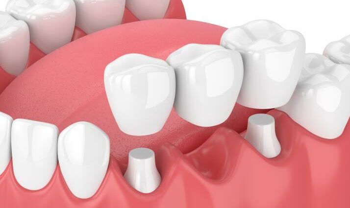 Best dentures and crowns: dentist&#8217;s advice