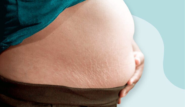 Big belly during pregnancy, causes