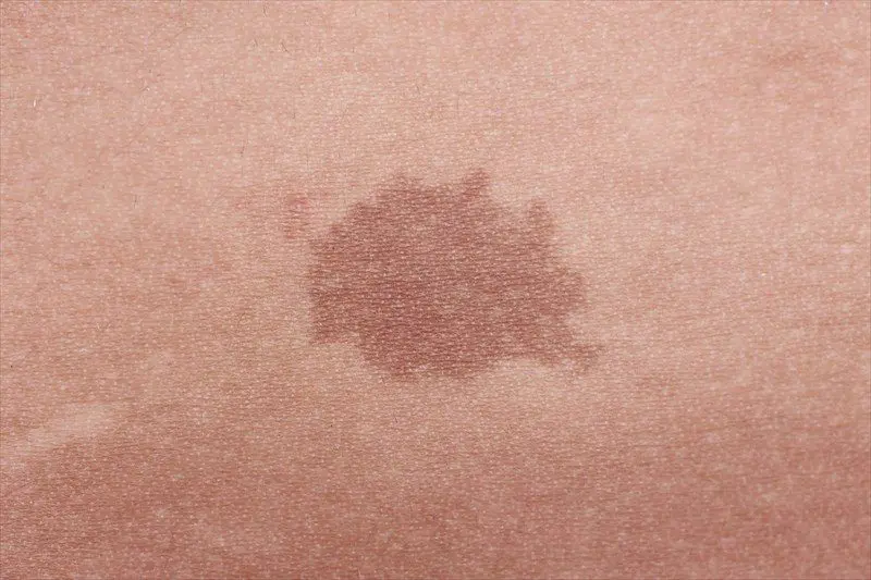 Birthmarks