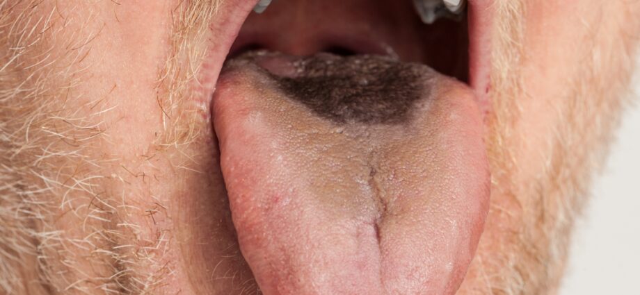 Black tongue: how to treat it?