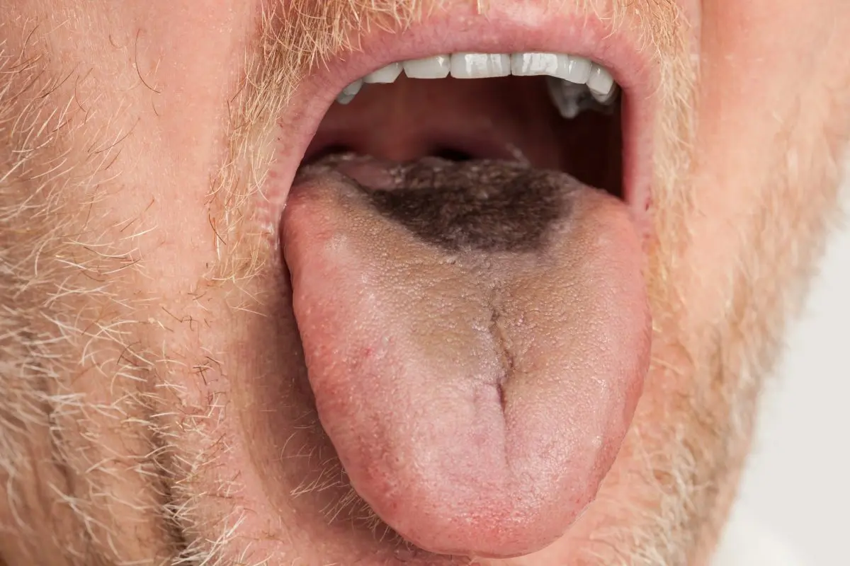 Black tongue: how to treat it?