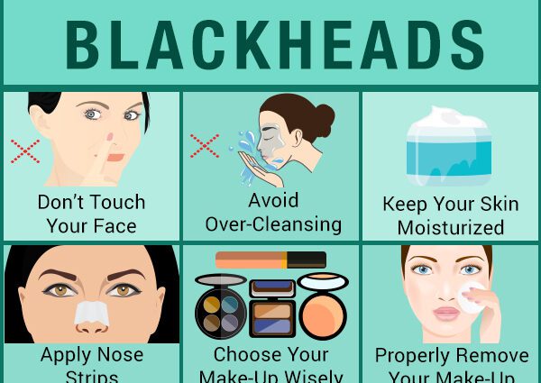 Blackheads: bagaimana cara menghilangkan komedo dari wajah?