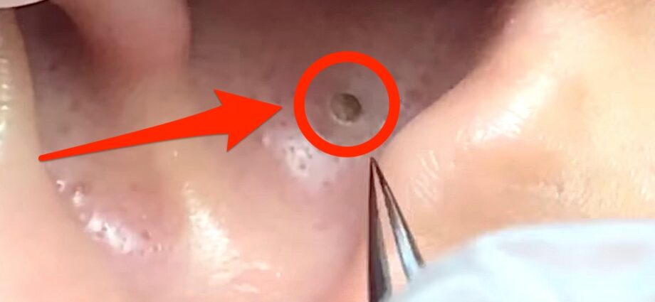 Blackheads in the ears: how to remove? Video