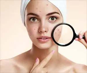 Blackheads on the face: how to remove safely? Video