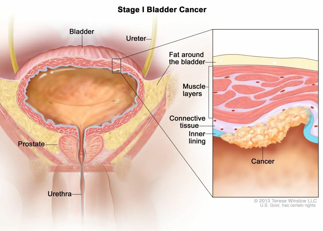 Bladder Cancer &#8211; Sites of Interest and Support Groups