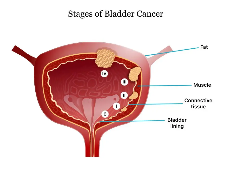 Bladder cancer