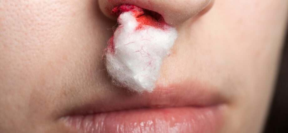 Bleeding from the nose: all you need to know about a bleeding nose