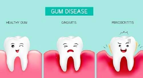 Bleeding gums