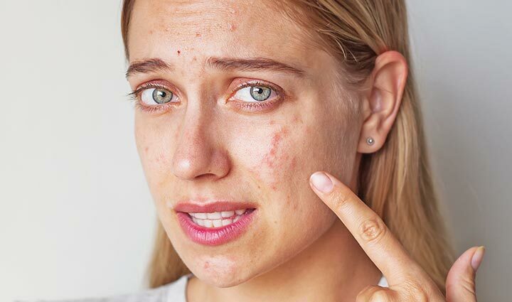 Blemish and acne marks: how to remove? Video