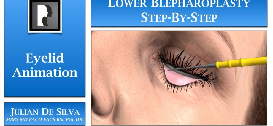 Blepharoplasty eyelid: facial plastic. Video