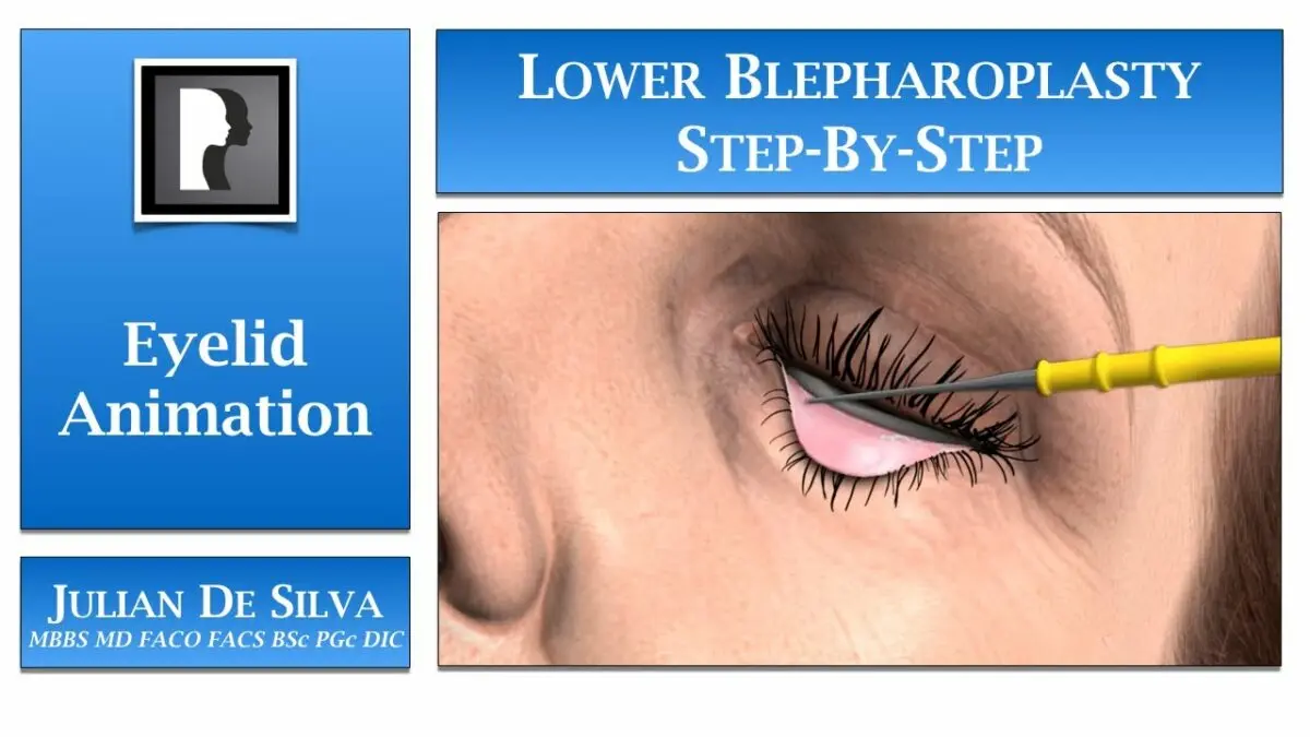 Blepharoplasty eyelid: facial plastic. Video