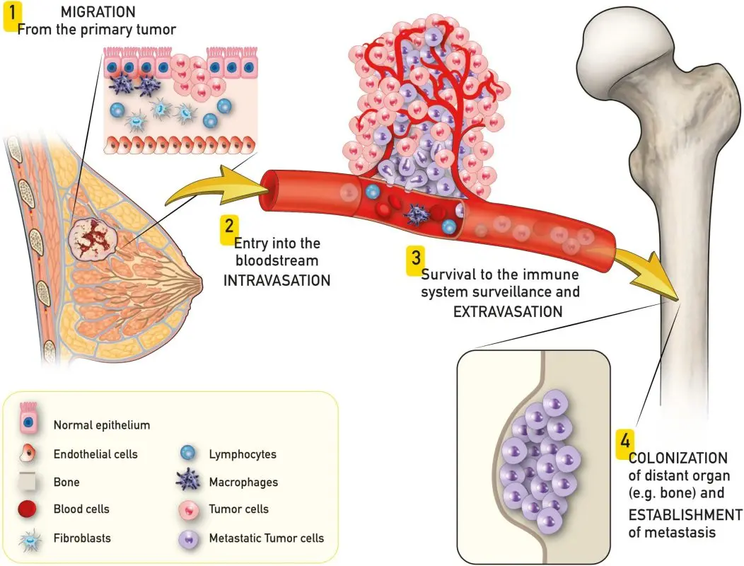 Bone metastasis