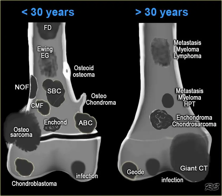 Bone tumors