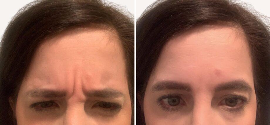 Botox vs lifting massage: comparing results, before and after photos