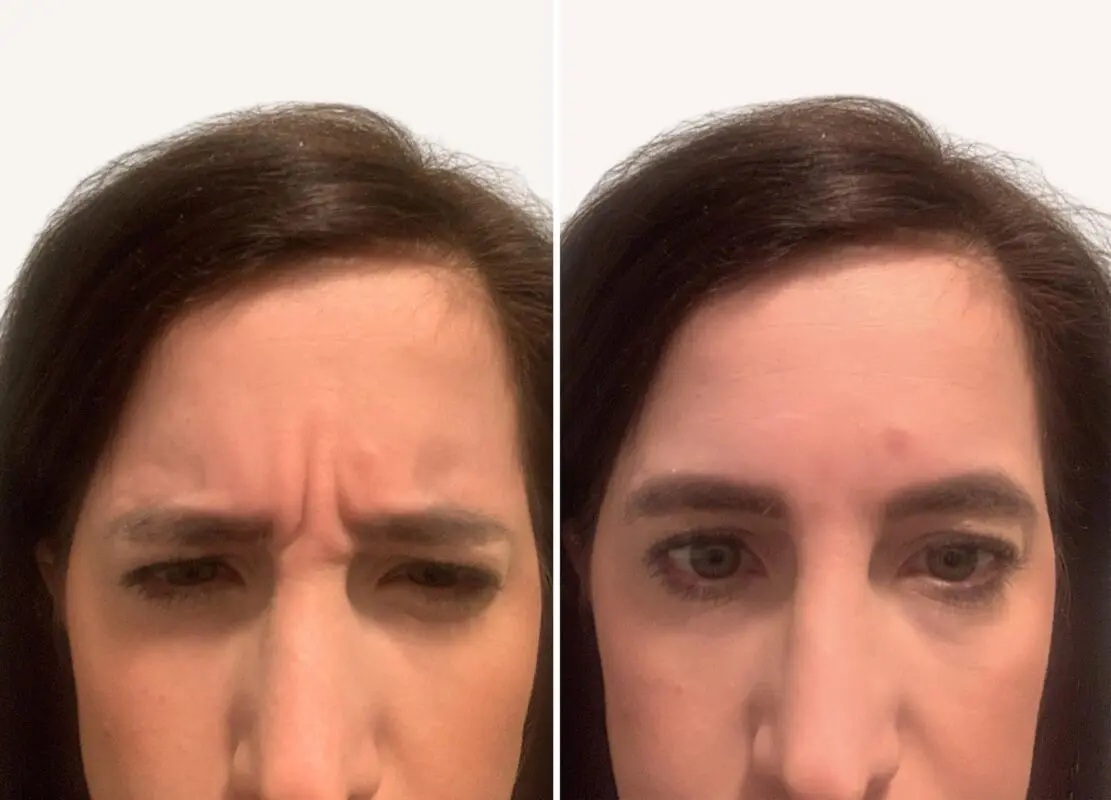 Botox vs lifting massage: comparing results, before and after photos