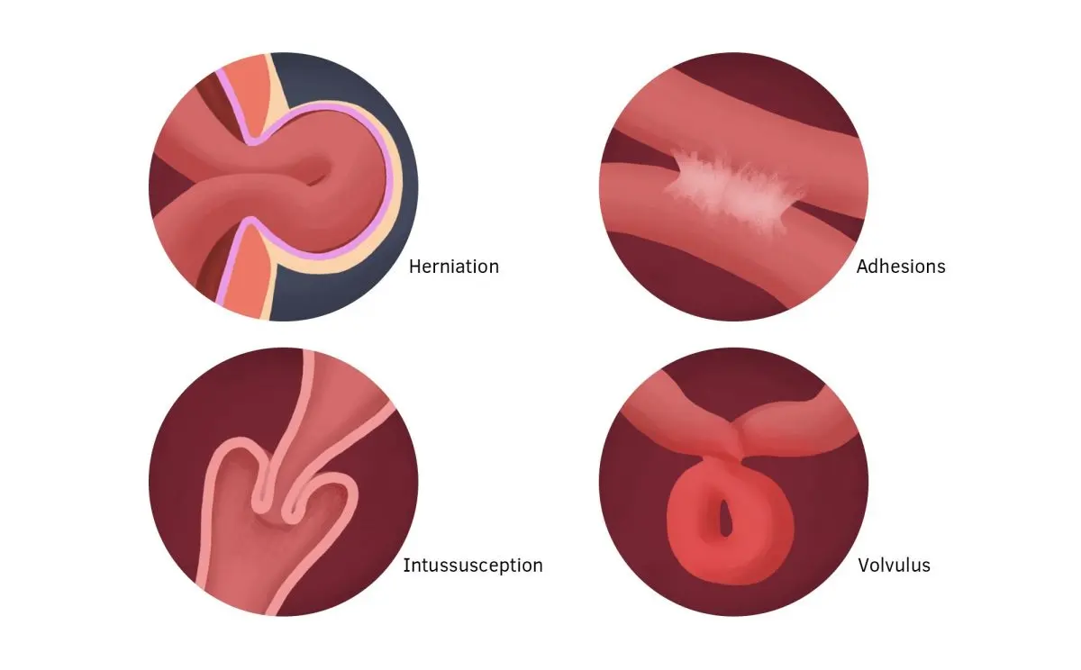 Bowel obstruction &#8211; Our doctor&#8217;s opinion