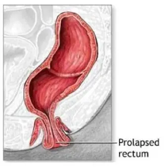 Bowel prolapse: symptoms, treatment, and exercise for bowel prolapse