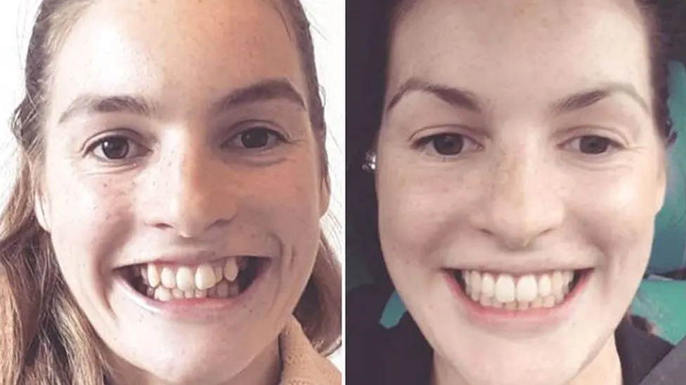 Braces after 30 years: can they straighten teeth forever?