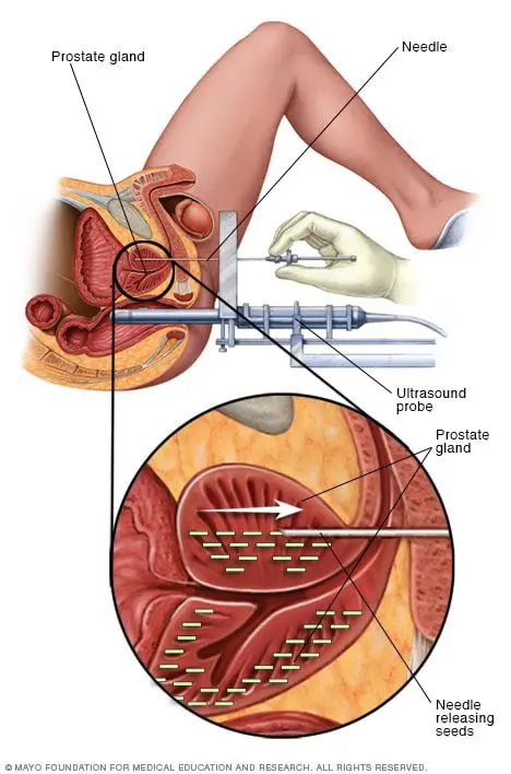 Brachytherapy