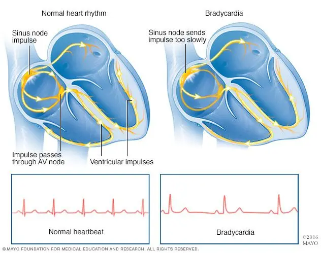 Bradycardia, what is it?