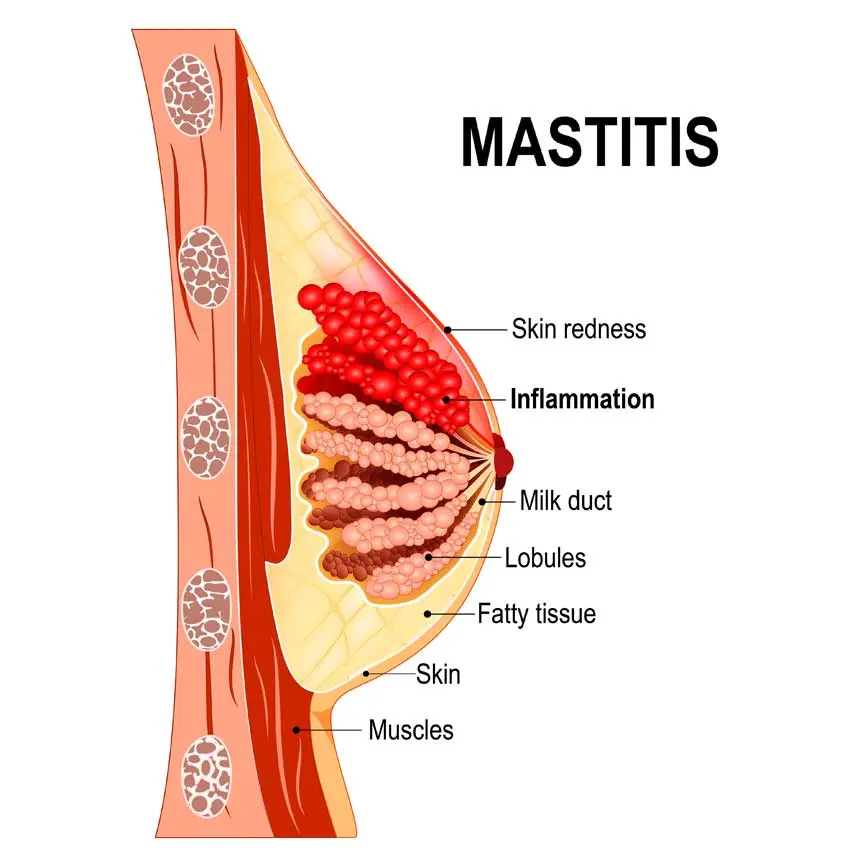 Breast abscess: how to treat it?