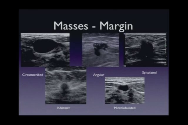 Breast cancer: breast ultrasound. Video