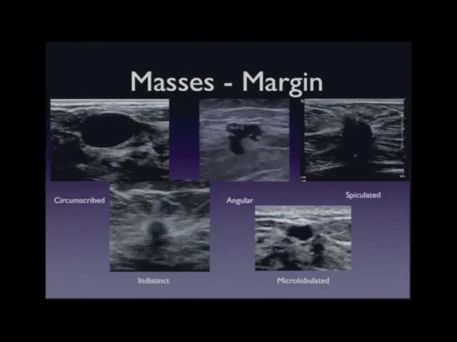 Breast cancer: breast ultrasound. Video