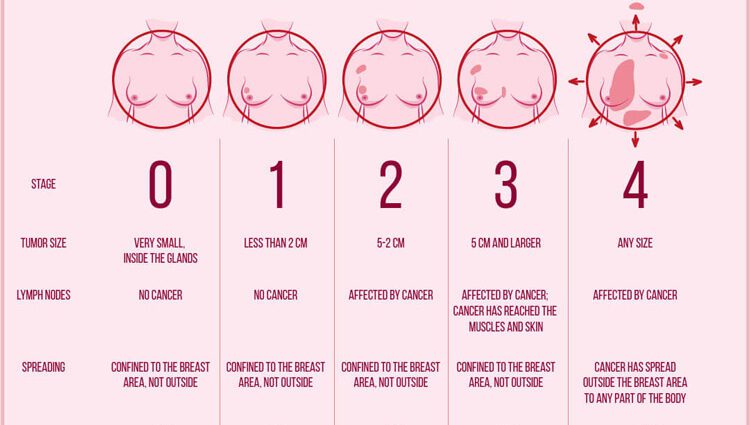 Breast cancer: symptoms, stages, treatment